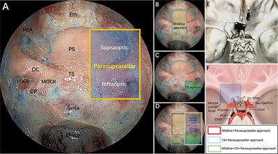 Endoscopic Endonasal Supraoptic and Infraoptic Approaches for Complex “Parasuprasellar” Lesions: Surgical Anatomy, Technique Nuances, and Case Series